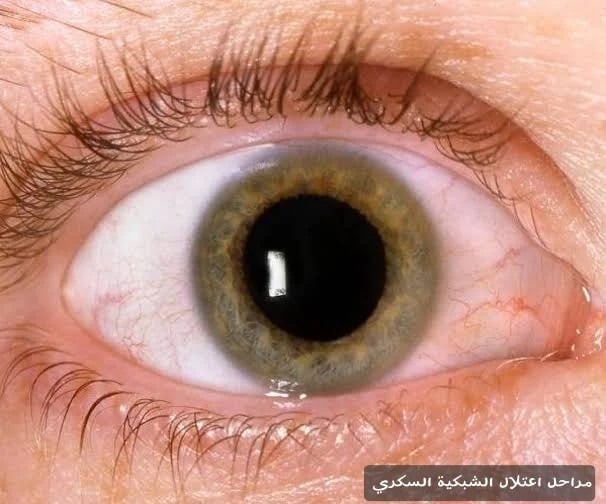 مراحل اعتلال الشبكية السكري 3 مراحل اعتلال الشبكية السكري
