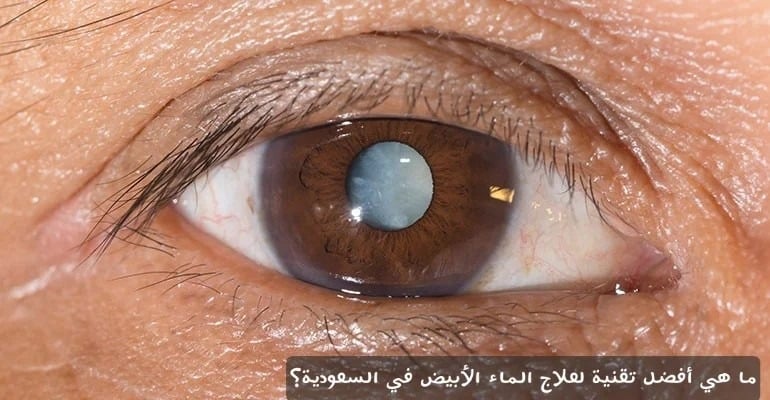 ما هي أفضل تقنية لعلاج الماء الأبيض في السعودية؟ 3 image 3 ما هي أفضل تقنية لعلاج الماء الأبيض في السعودية؟