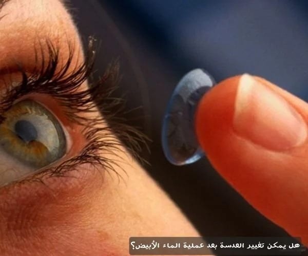 هل يمكن تغيير العدسة بعد عملية الماء الأبيض؟ 1 image هل يمكن تغيير العدسة بعد عملية الماء الأبيض؟