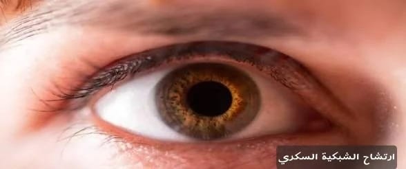 ارتشاح الشبكية السكري 8 ارتشاح الشبكية السكري