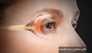 علاج ارتشاح مركز الإبصار