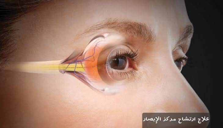 علاج ارتشاح مركز الإبصار 1 علاج ارتشاح مركز الإبصار