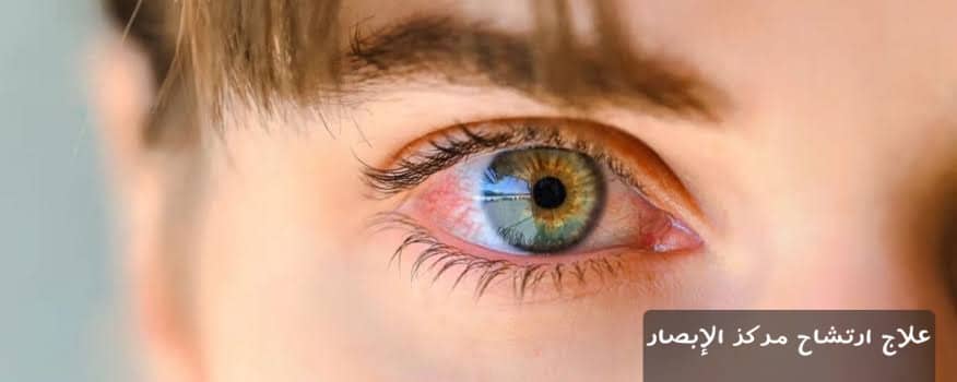 علاج ارتشاح مركز الإبصار 3 image 3 علاج ارتشاح مركز الإبصار