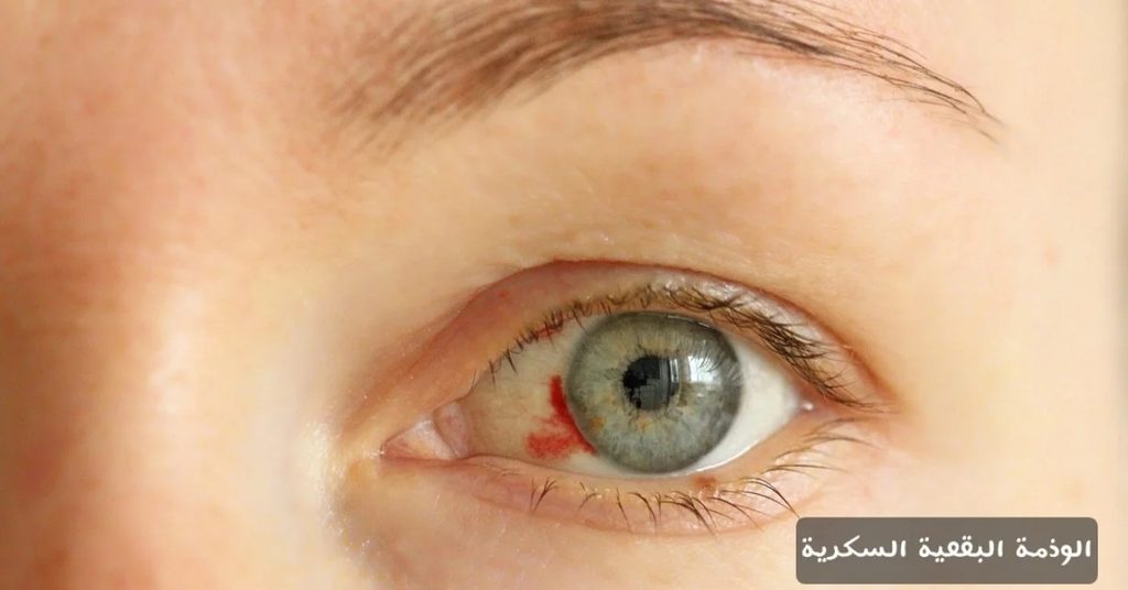 الوذمة البقعية السكرية 3 image 4 الوذمة البقعية السكرية