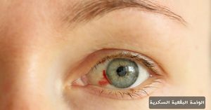 المدونة 3 الوذمة البقعية السكرية
