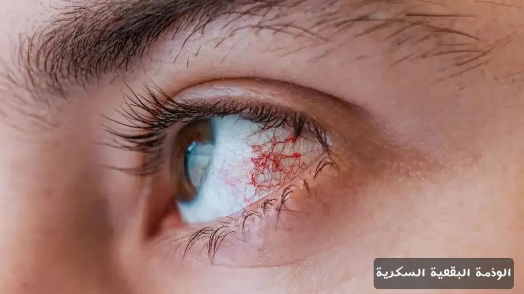 الوذمة البقعية السكرية 1 الوذمة البقعية السكرية