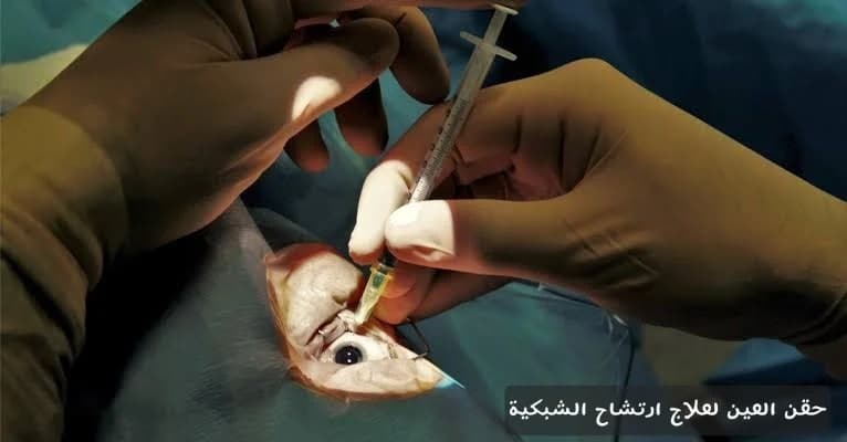 حقن العين لعلاج ارتشاح الشبكية 1 image 8 حقن العين لعلاج ارتشاح الشبكية