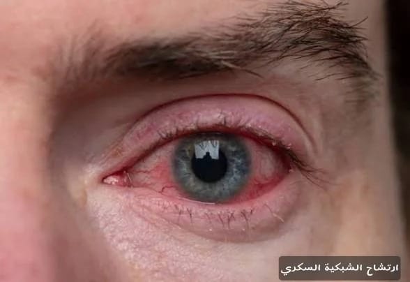 ارتشاح الشبكية السكري 1 image ارتشاح الشبكية السكري